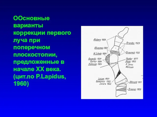 ООсновные варианты коррекции первого луча при поперечном плоскостопии, предложенные в начале XX века. (цит.по P.Lapidus, 1960)