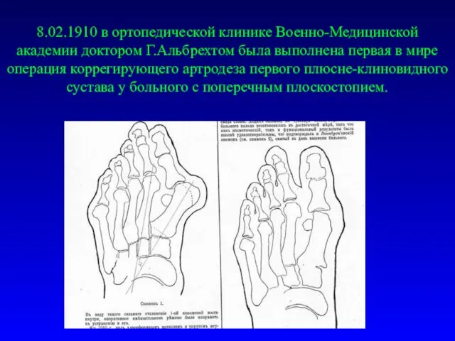 8.02.1910 в ортопедической клинике Военно-Медицинской академии доктором Г.Альбрехтом была выполнена