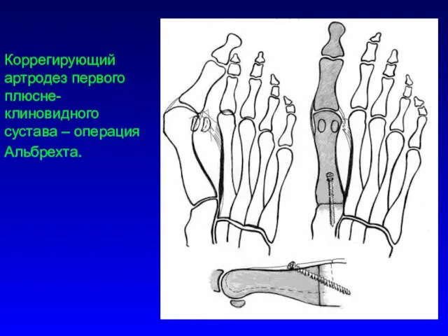 Коррегирующий артродез первого плюсне-клиновидного сустава – операция Альбрехта.