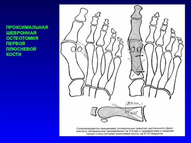 ПРОКСИМАЛЬНАЯ ШЕВРОННАЯ ОСТЕОТОМИЯ ПЕРВОЙ ПЛЮСНЕВОЙ КОСТИ