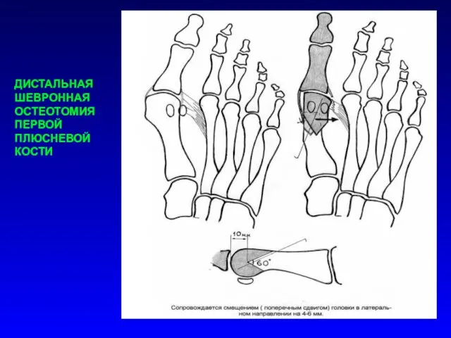 ДИСТАЛЬНАЯ ШЕВРОННАЯ ОСТЕОТОМИЯ ПЕРВОЙ ПЛЮСНЕВОЙ КОСТИ