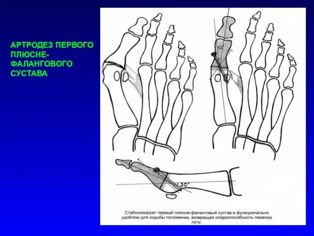 АРТРОДЕЗ ПЕРВОГО ПЛЮСНЕ-ФАЛАНГОВОГО СУСТАВА