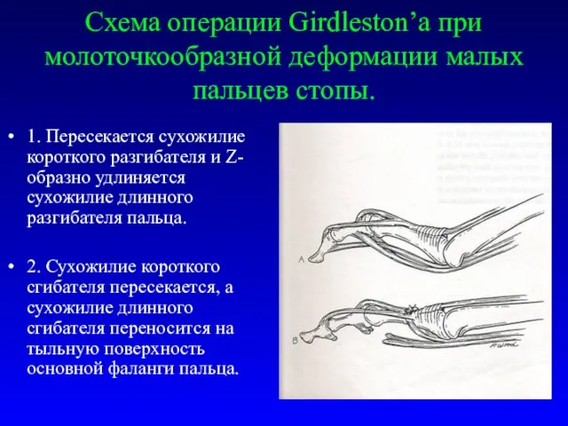Схема операции Girdleston’а при молоточкообразной деформации малых пальцев стопы. 1.