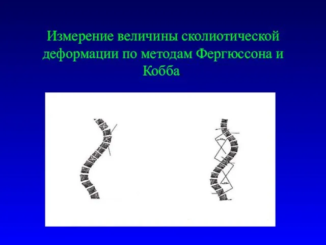 Измерение величины сколиотической деформации по методам Фергюссона и Кобба.