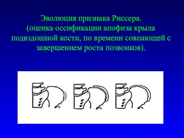 Эволюция признака Риссера. (оценка оссификации апофиза крыла подвздошной кости, по времени совпающей с завершением роста позвонков).