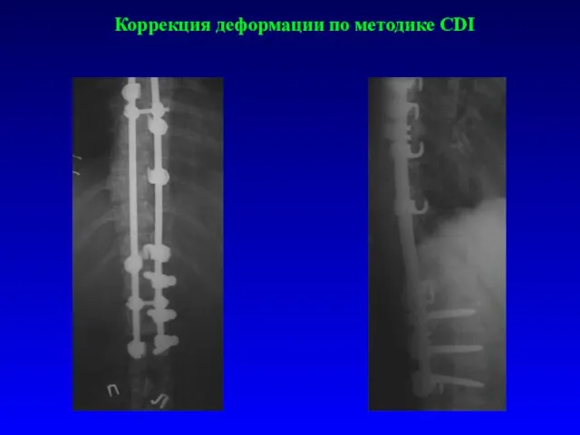 Коррекция деформации по методике CDI