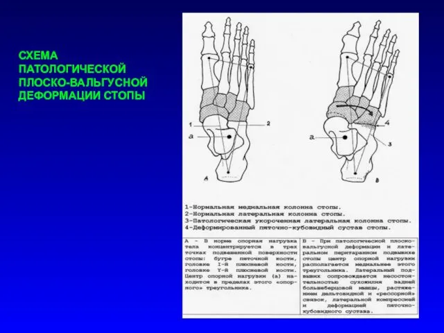 СХЕМА ПАТОЛОГИЧЕСКОЙ ПЛОСКО-ВАЛЬГУСНОЙ ДЕФОРМАЦИИ СТОПЫ