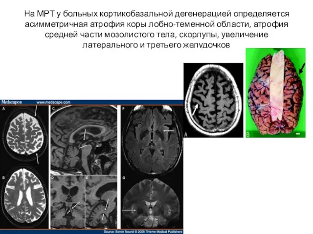 На МРТ у больных кортикобазальной дегенерацией определяется асимметричная атрофия коры