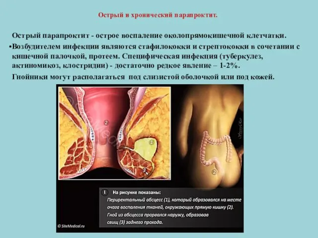 Острый и хронический парапроктит. Острый парапроктит - острое воспаление околопрямокишечной