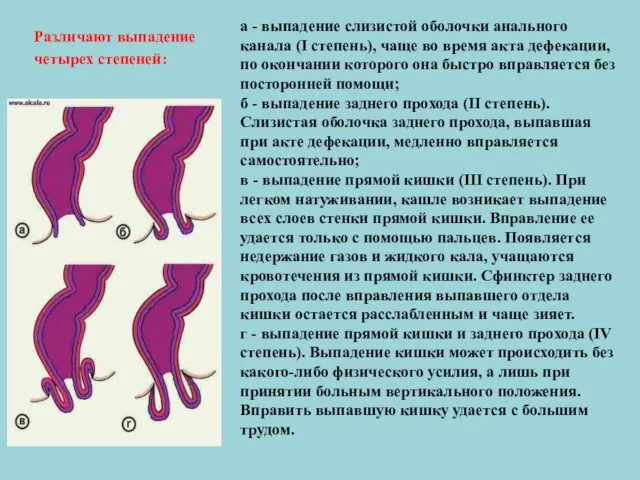 а - выпадение слизистой оболочки анального канала (I степень), чаще