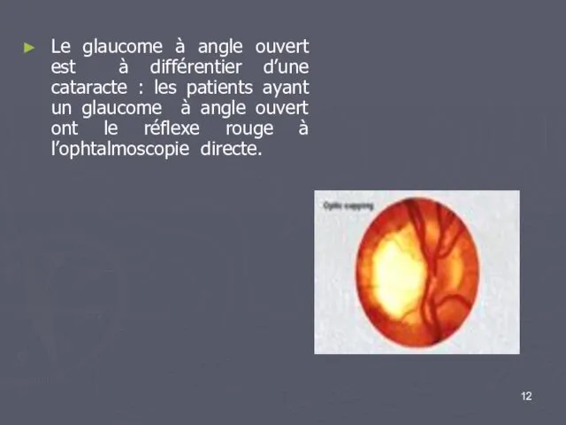Le glaucome à angle ouvert est à différentier d’une cataracte