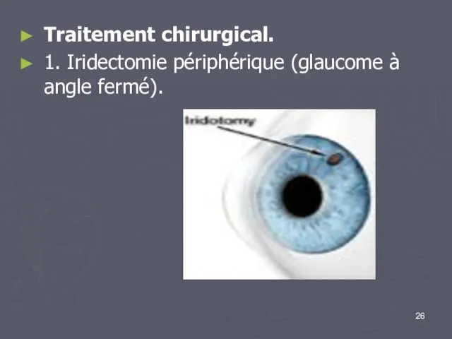 Traitement chirurgical. 1. Iridectomie périphérique (glaucome à angle fermé).
