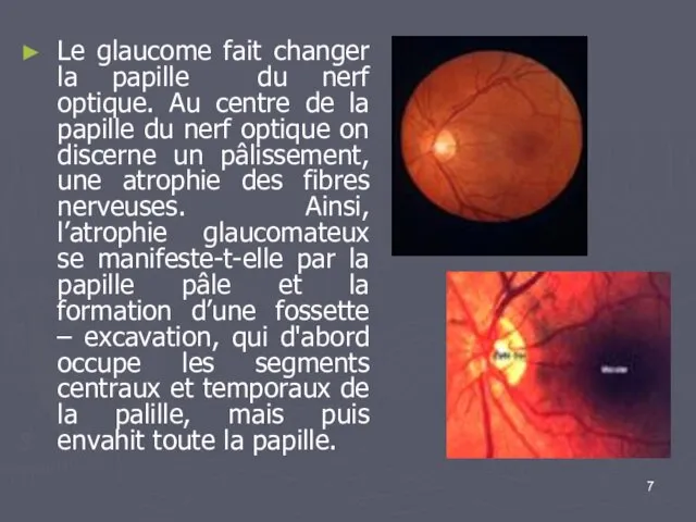 Le glaucome fait changer la papille du nerf optique. Au