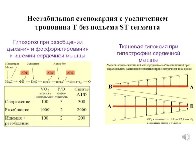 Нестабильная стенокардия с увеличением тропонина Т без подъема ST сегмента