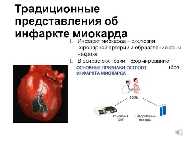 Традиционные представления об инфаркте миокарда Инфаркт миокарда – окклюзия коронарной