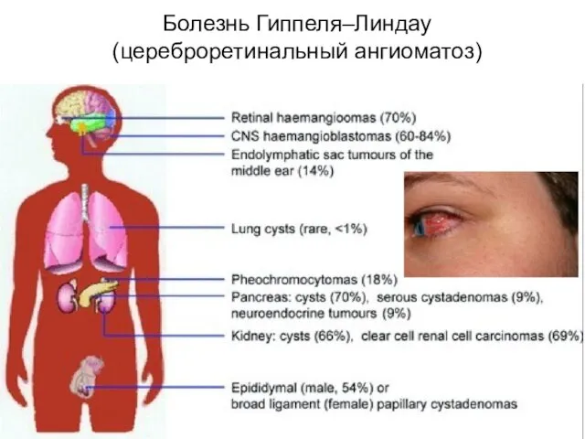 Болезнь Гиппеля–Линдау (цереброретинальный ангиоматоз)