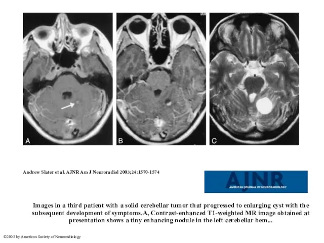 Images in a third patient with a solid cerebellar tumor