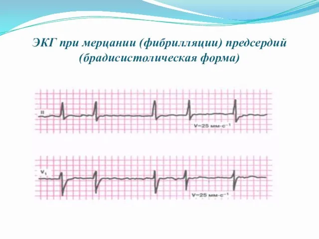 ЭКГ при мерцании (фибрилляции) предсердий (брадисистолическая форма)