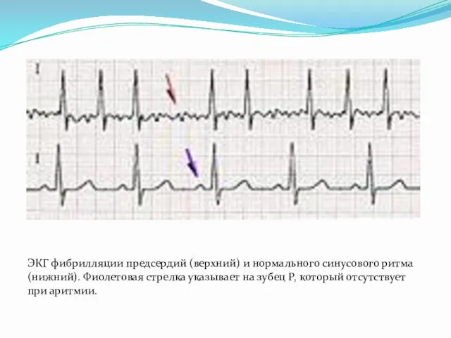 ЭКГ фибрилляции предсердий (верхний) и нормального синусового ритма (нижний). Фиолетовая