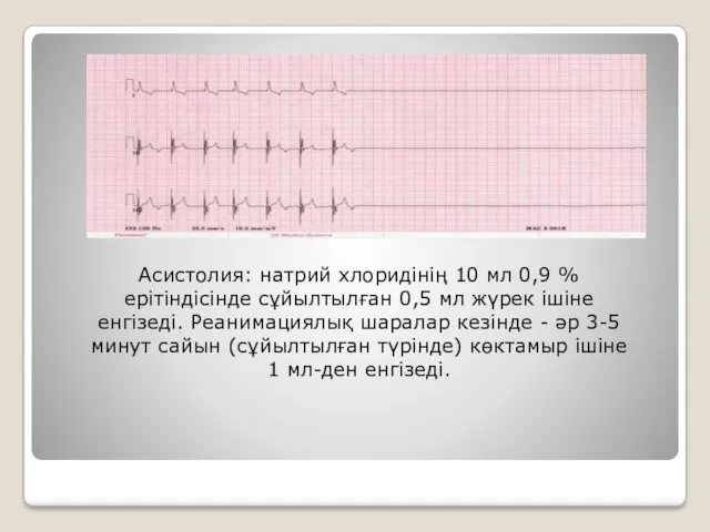 Асистолия: натрий хлоридінің 10 мл 0,9 % ерітіндісінде сұйылтылған 0,5