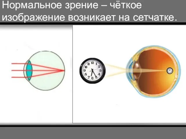 Нормальное зрение – чёткое изображение возникает на сетчатке.