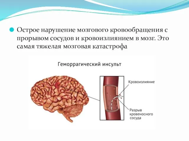 Острое нарушение мозгового кровообращения с прорывом сосудов и кровоизлиянием в мозг. Это самая тяжелая мозговая катастрофа