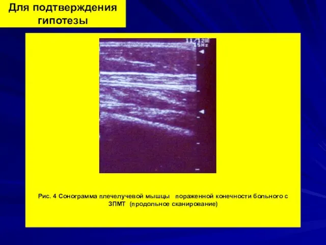Для подтверждения гипотезы Рис. 4 Сонограмма плечелучевой мышцы пораженной конечности больного с ЗПМТ (продольное сканирование)