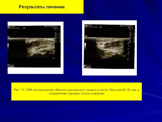 Результаты лечения Рис. 11. УЗИ исследование области карпального канала и