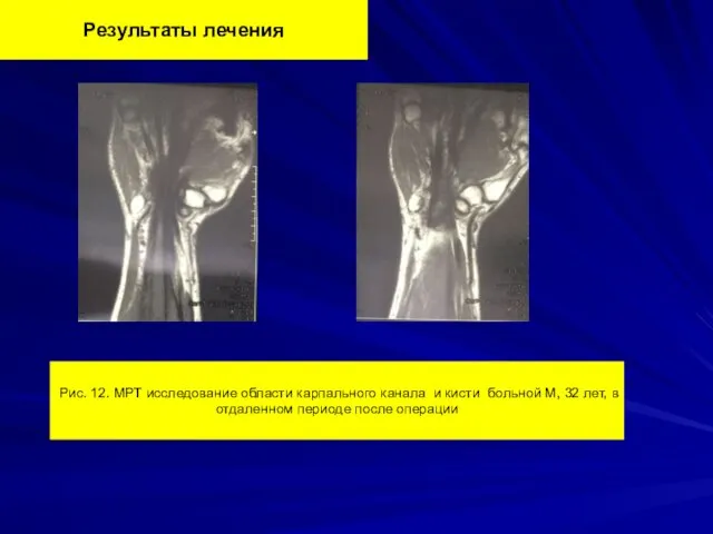 Результаты лечения Рис. 12. МРТ исследование области карпального канала и
