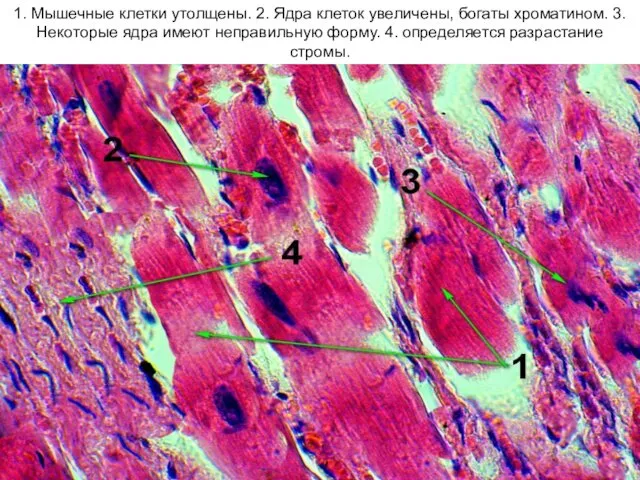 1. Мышечные клетки утолщены. 2. Ядра клеток увеличены, богаты хроматином.