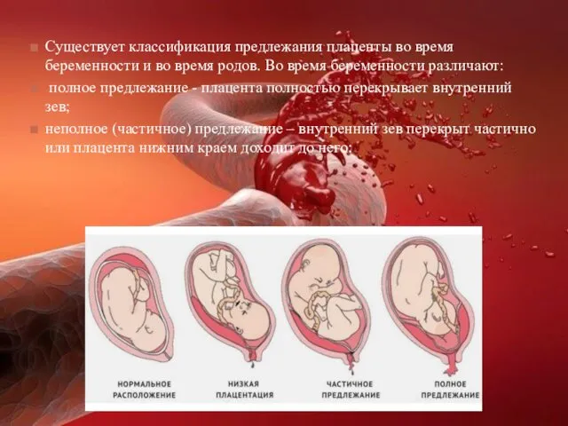 Существует классификация предлежания плаценты во время беременности и во время