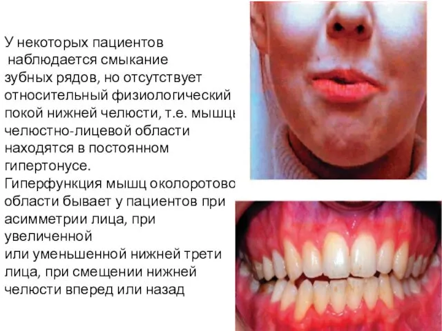 У некоторых пациентов наблюдается смыкание зубных рядов, но отсутствует относительный