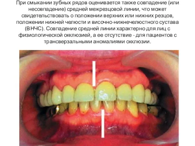 При смыкании зубных рядов оценивается также совпадение (или несовпадение) средней
