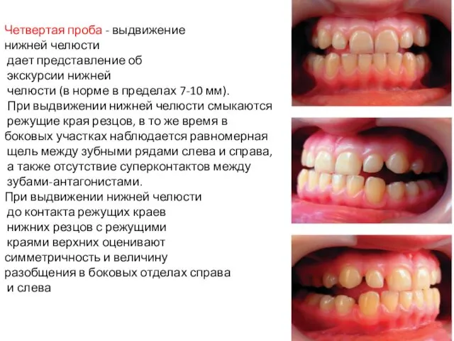 Четвертая проба - выдвижение нижней челюсти дает представление об экскурсии