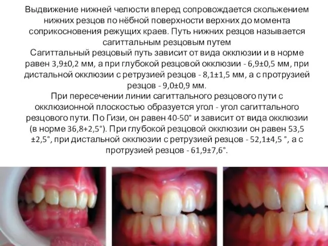 Выдвижение нижней челюсти вперед сопровождается скольжением нижних резцов по нёбной