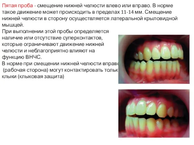 Пятая проба - смещение нижней челюсти влево или вправо. В