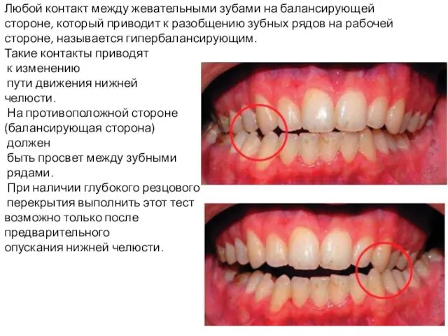 Любой контакт между жевательными зубами на балансирующей стороне, который приводит