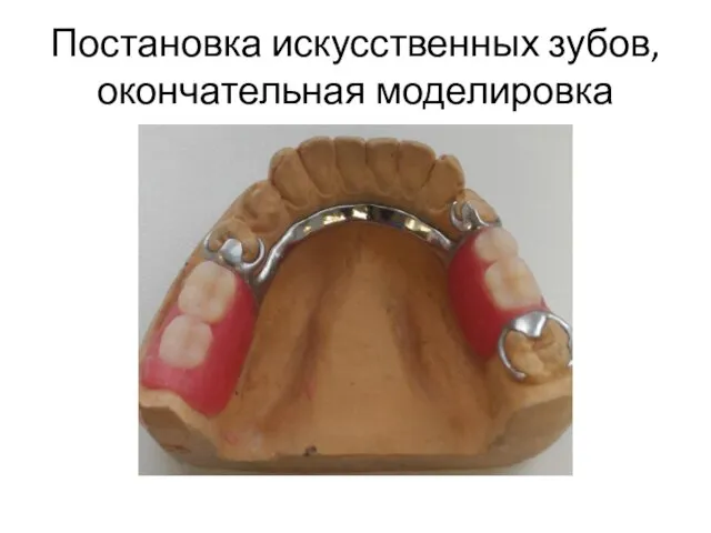 Постановка искусственных зубов, окончательная моделировка