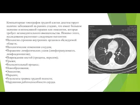 Компьютерная томография грудной клетки диагностирует наличие заболеваний на ранних стадиях,