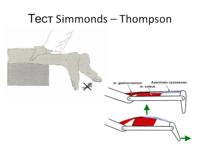 Тест Simmonds – Thompson