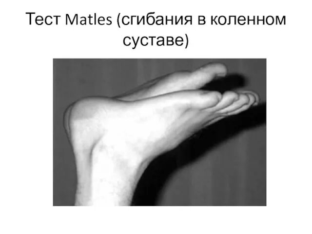 Тест Matles (сгибания в коленном суставе)