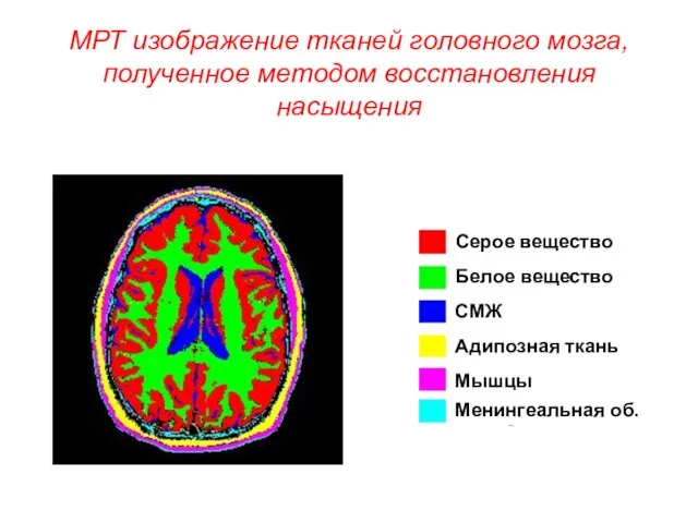 МРТ изображение тканей головного мозга, полученное методом восстановления насыщения