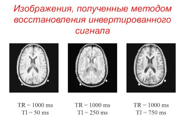 Изображения, полученные методом восстановления инвертированного сигнала TR = 1000 ms