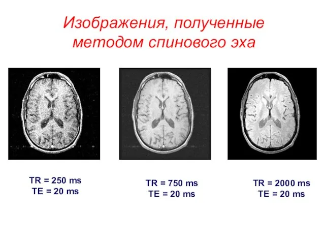 Изображения, полученные методом спинового эха TR = 250 ms TE