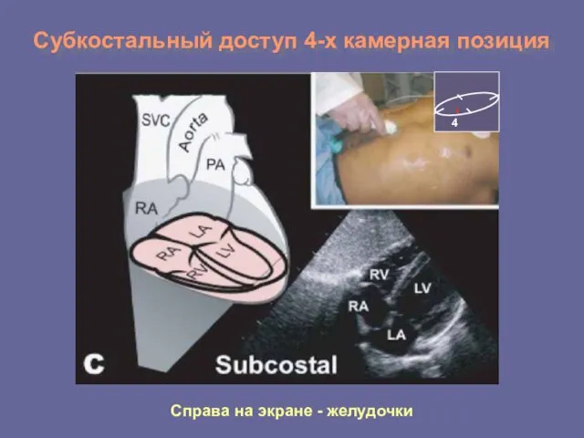 Субкостальный доступ 4-х камерная позиция Справа на экране - желудочки 4