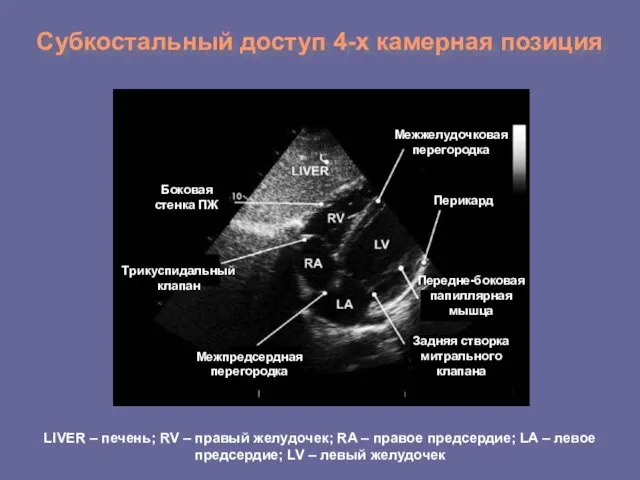 Субкостальный доступ 4-х камерная позиция Боковая стенка ПЖ Трикуспидальный клапан