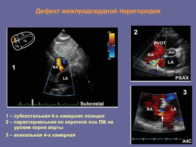 Дефект межпредсердной перегородки 1 2 3 1 – субкостальная 4-х