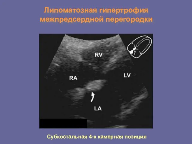 Липоматозная гипертрофия межпредсердной перегородки Субкостальная 4-х камерная позиция