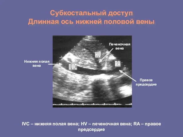 Субкостальный доступ Длинная ось нижней половой вены IVC – нижняя