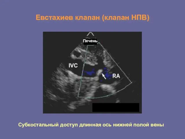 Евстахиев клапан (клапан НПВ) Субкостальный доступ длинная ось нижней полой вены Печень